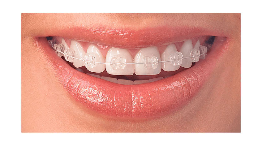 Ortodoncja cyfrowa – sposób na proste zęby
