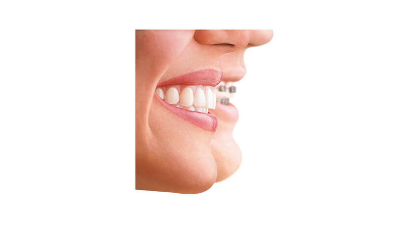 ortodoncja sposób na proste zęby